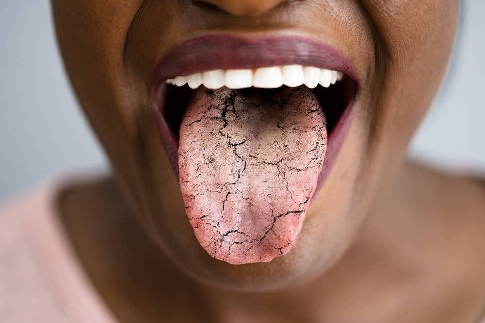 Xerostomia (Image via Getty Images)